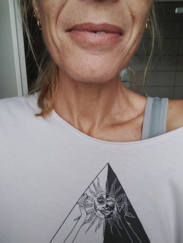 Morpheus ou HIFU : quelle technique choisir ?