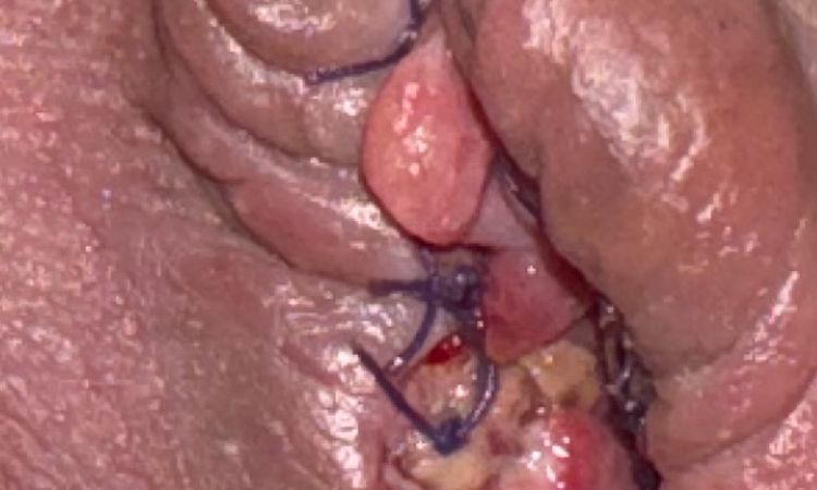 Nymphoplastie : Est-ce une infection ? - 71945