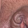 Nymphoplastie : Est-ce une infection ?