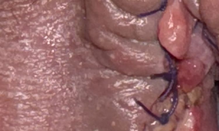 Nymphoplastie : Est-ce une infection ? - 71946