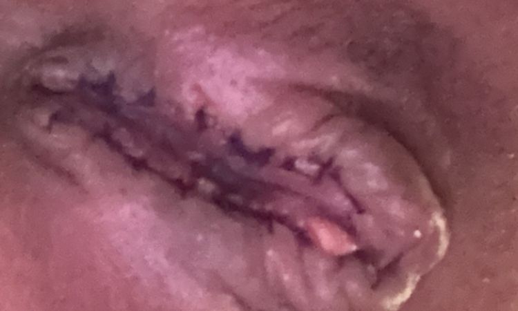 Nymphoplastie : Est-ce une infection ? - 71947