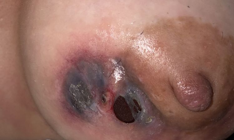 Nécrose après augmentation mammaire - 72142