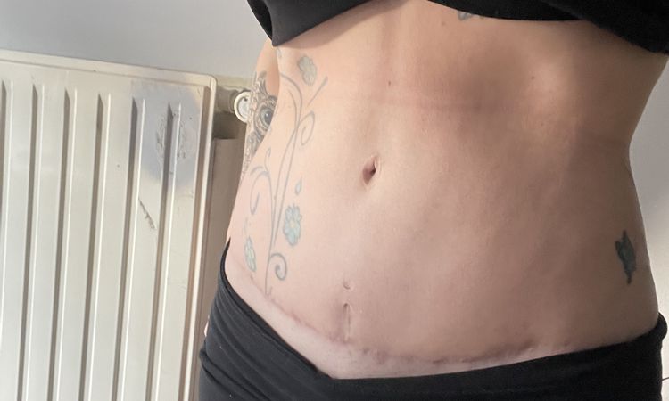 Ventre dur et tendu après abdominoplastie - 72319