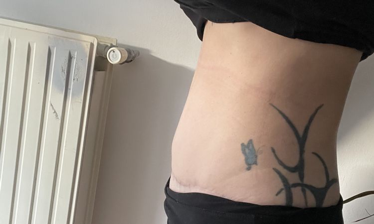 Ventre dur et tendu après abdominoplastie - 72320