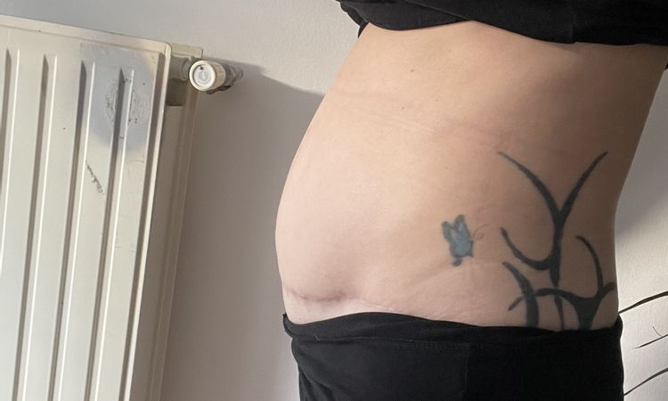 Ventre dur et tendu après abdominoplastie - 72321