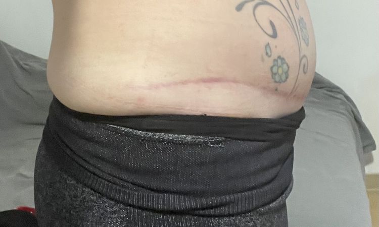 Ventre dur et tendu après abdominoplastie - 72322