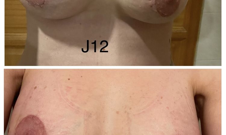 Quelles évolutions pour la taille des mamelons ? - 73645