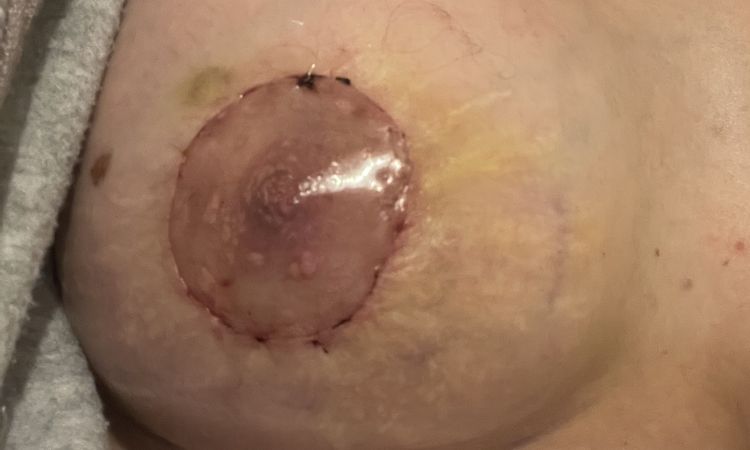Quelles évolutions pour la taille des mamelons ? - 73647