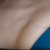 Cicatrice hypertrophique : Veines bleues après injection de Kenacort