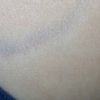 Cicatrice hypertrophique : Veines bleues après injection de Kenacort - 73848