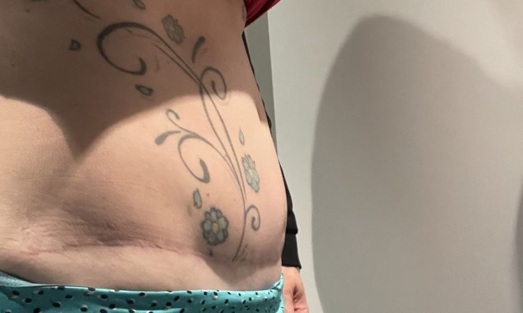 Abdominoplastie à six mois post-opératoire - 73996