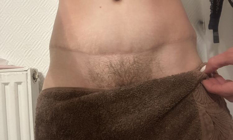 "Oreilles" après abdominoplatie - 74945