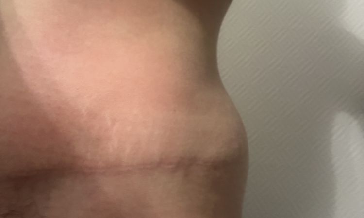 "Oreilles" après abdominoplatie - 74946