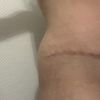 "Oreilles" après abdominoplatie