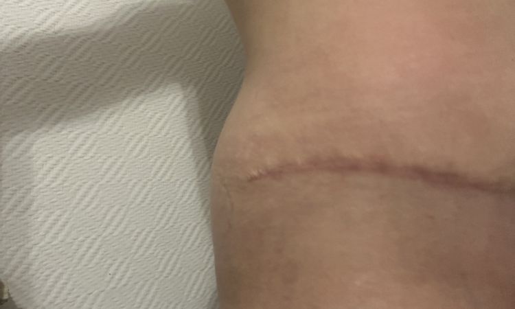 "Oreilles" après abdominoplatie - 74947