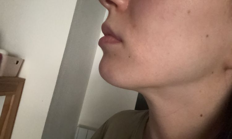 Double menton - jawline - 76683