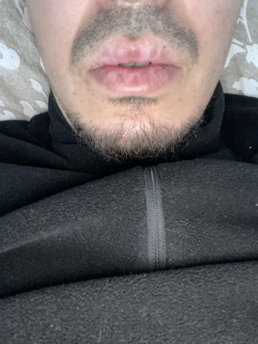 Taches blanches sur les lèvres