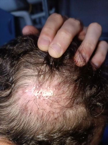 Est-ce un kyste ou une inflammation ?