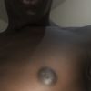 Gynécomastie sans chirurgie