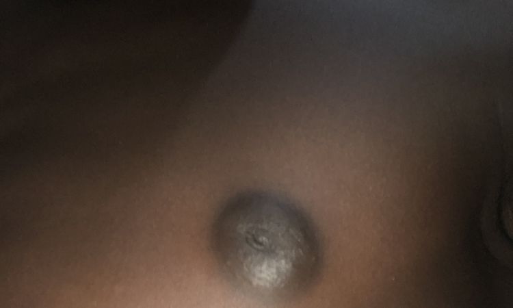 Gynécomastie sans chirurgie - 80548