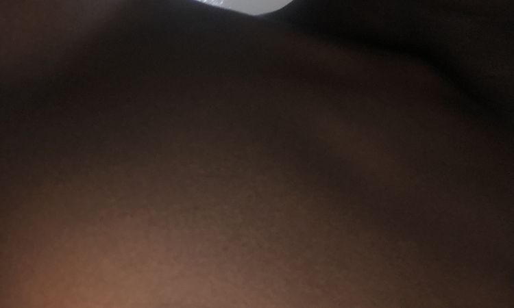 Gynécomastie sans chirurgie - 80549