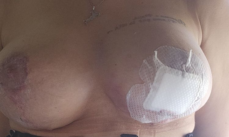 Augmentation mammaire et correction de ptôse - 80913
