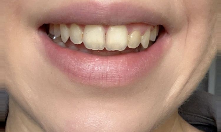 Problème post injection lèvres - 81070