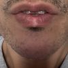 Quelle solution pour une cicatrice blanche au milieu de la lèvre inferieure ?