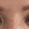 Évolution blépharoplastie à J+24