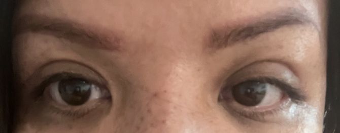 Évolution blépharoplastie à J+24 - 81380