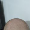 Dermopigmentation du crâne