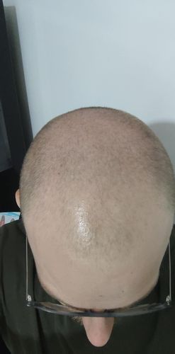 Dermopigmentation du crâne
