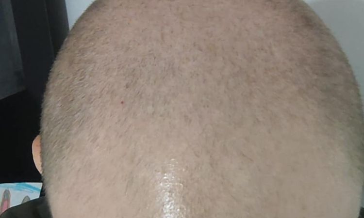 Dermopigmentation du crâne - 81874
