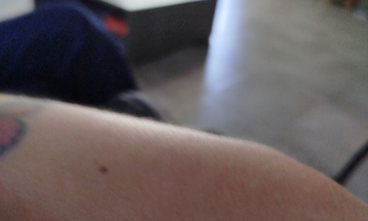 J'ai des cicatrices sur les bras - 82030
