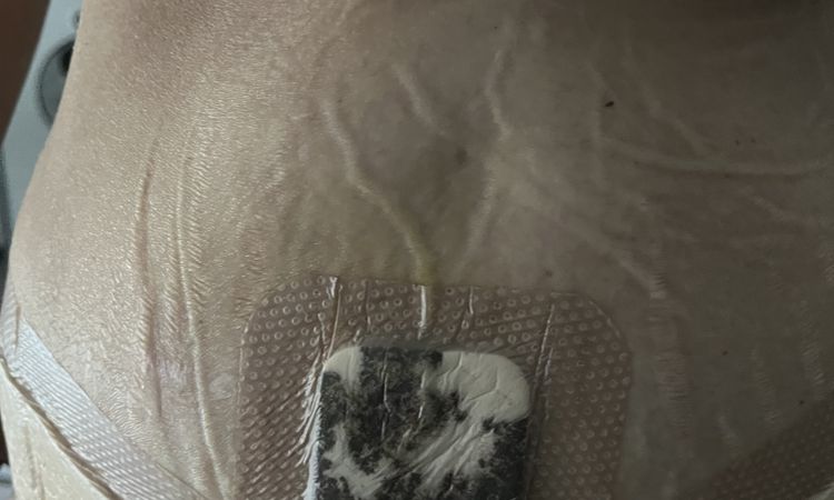 Saignement au nombril après abdominoplastie - 82516