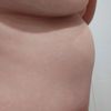 Gonflement sous la poitrine après abdominoplastie