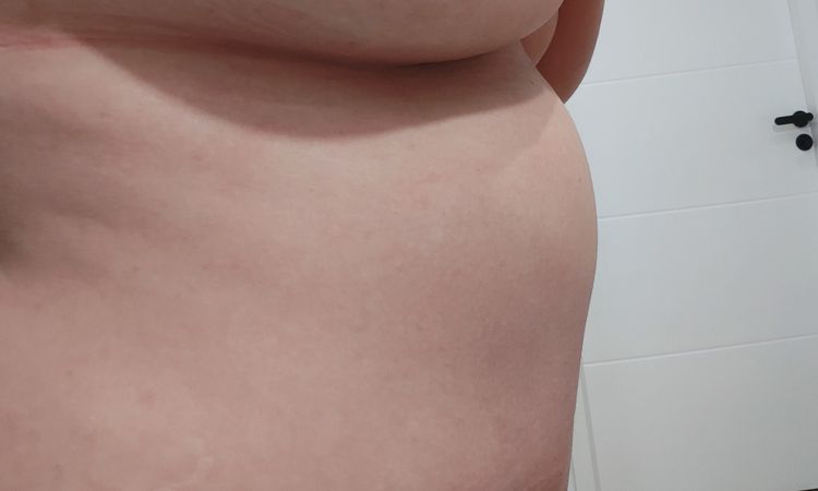 Gonflement sous la poitrine après abdominoplastie - 82585