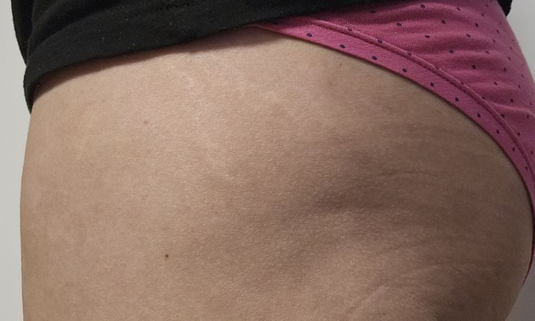 Lipofilling culotte de cheval après liposuccion - 82657