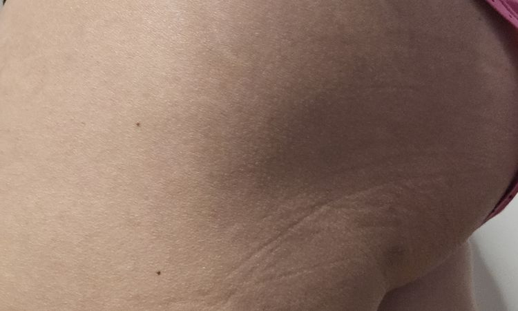 Lipofilling culotte de cheval après liposuccion - 82658