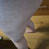 Lipofilling culotte de cheval après liposuccion