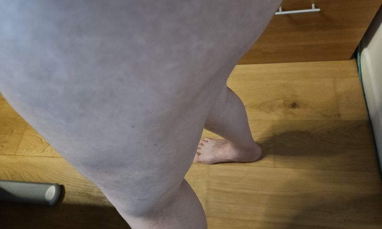 Lipofilling culotte de cheval après liposuccion - 82659