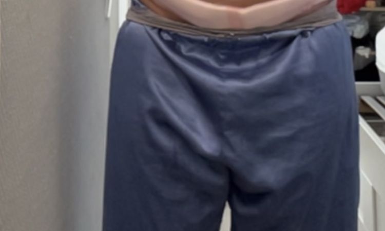 Poignées d’amour après abdominoplastie sans liposuccion - 82666