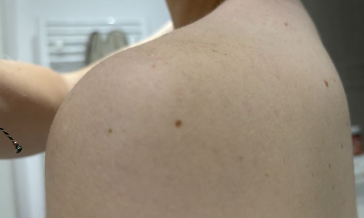 Varicosités sur les épaules - 82692