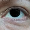 Reprise possible blépharoplastie inférieure ?