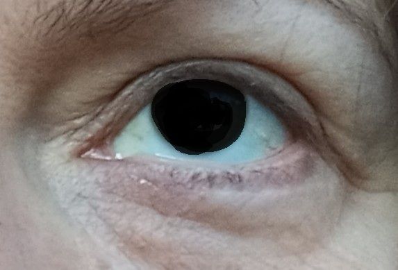 Reprise possible blépharoplastie inférieure ? - 82726