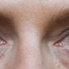 Reprise possible blépharoplastie inférieure ?