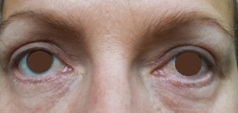 Reprise possible blépharoplastie inférieure ? - 82727