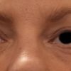 Reprise possible blépharoplastie inférieure ?