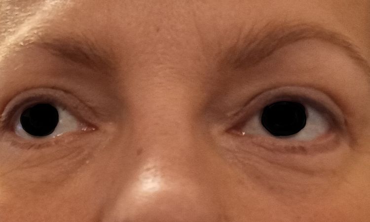 Reprise possible blépharoplastie inférieure ? - 82728
