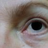 Reprise possible blépharoplastie inférieure ?